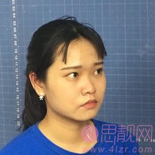 脸博士整形美容做埋线提升怎么样？2020价格表曝光+埋线提升真人分享案例