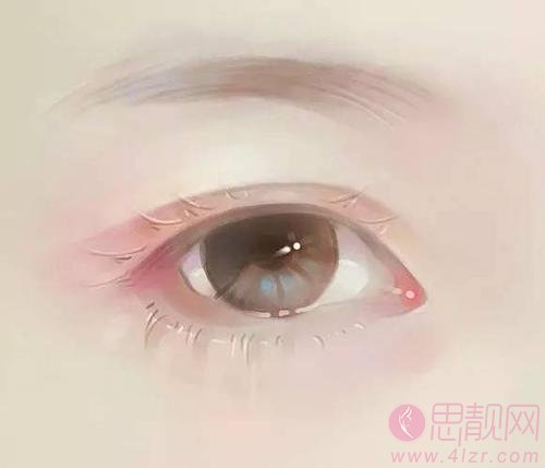 有肿泡眼怎么选择眼部手术