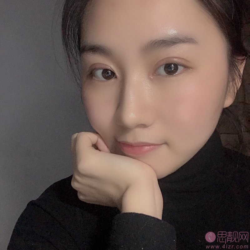 长沙雅美医疗美容医院赵茜医生做双眼皮怎么样？2020价格表一览+双眼皮真人案例分享