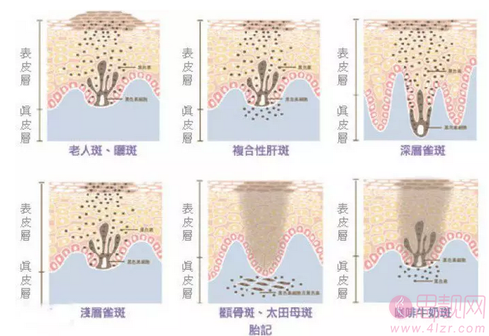 激光祛斑会反弹吗？术后要如何护理