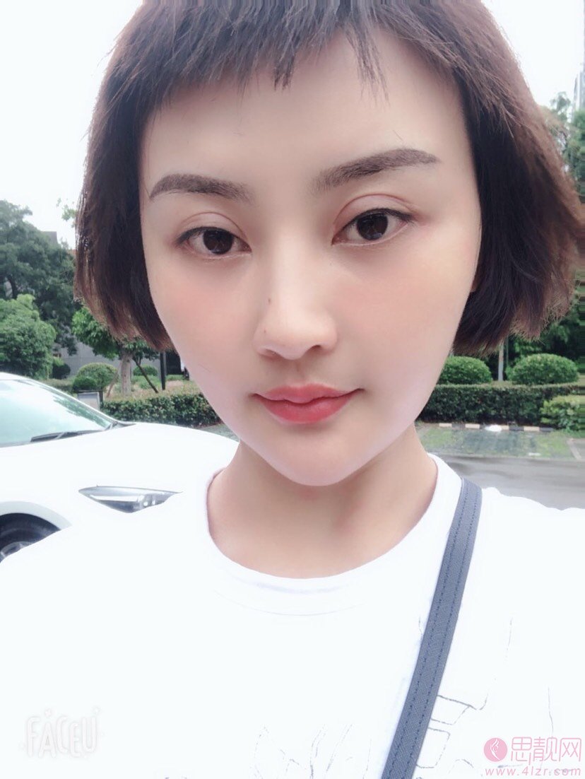 成都高新莱尹臻颜医疗美容门诊部刘海兰做双眼皮修复如何？2020价格表曝光+双眼皮修复前后对比效果