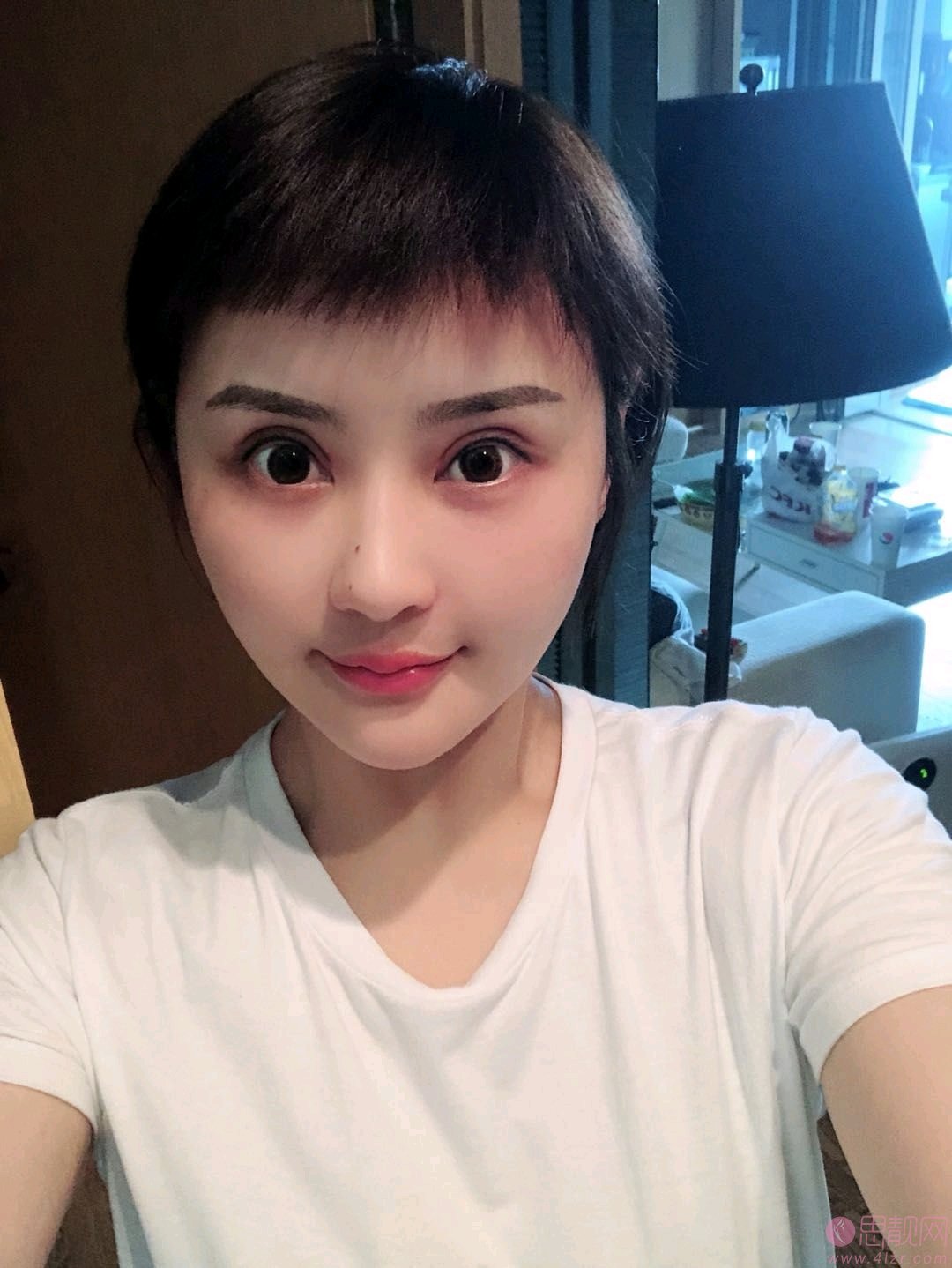 成都高新莱尹臻颜医疗美容门诊部刘海兰做双眼皮修复如何？2020价格表曝光+双眼皮修复前后对比效果