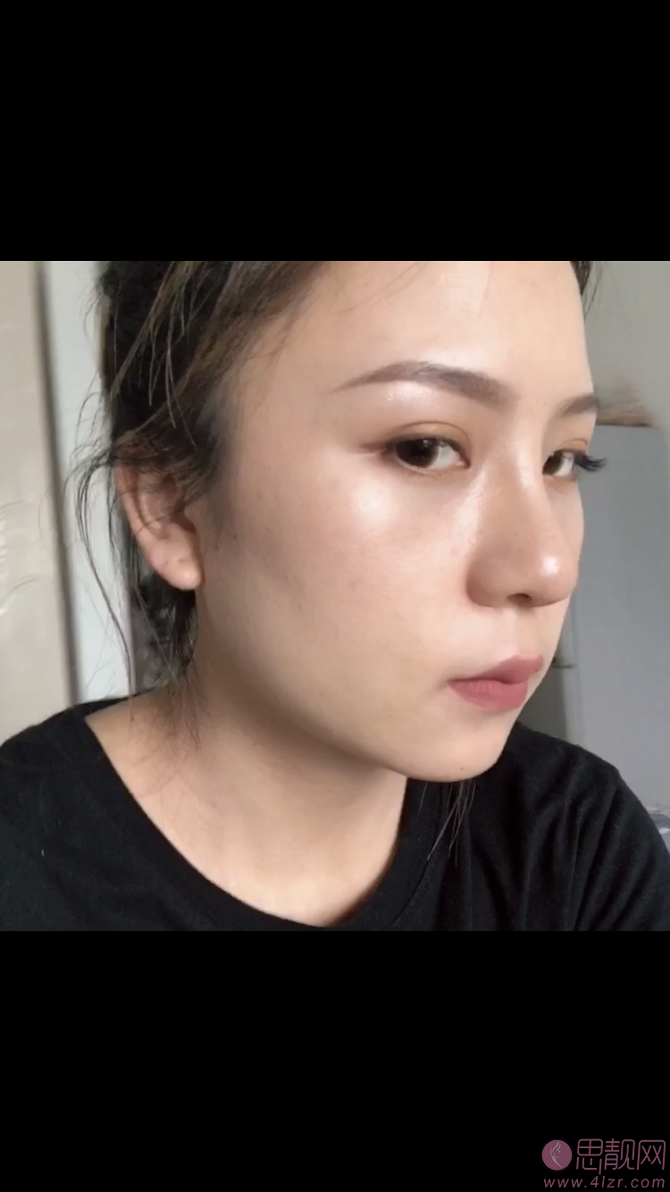 成都格莱丽整形美容肖凌隆鼻怎么样.2020价格表一览+术后恢复案例展现