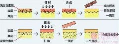 强脉冲光和激光，到底有啥区别？