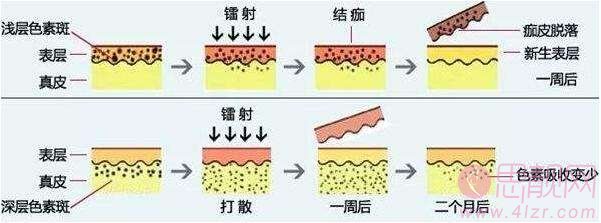 强脉冲光和激光，到底有啥区别？ 