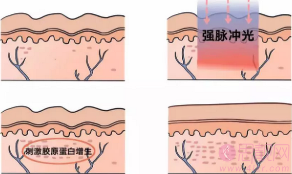 强脉冲光和激光，到底有啥区别？ 