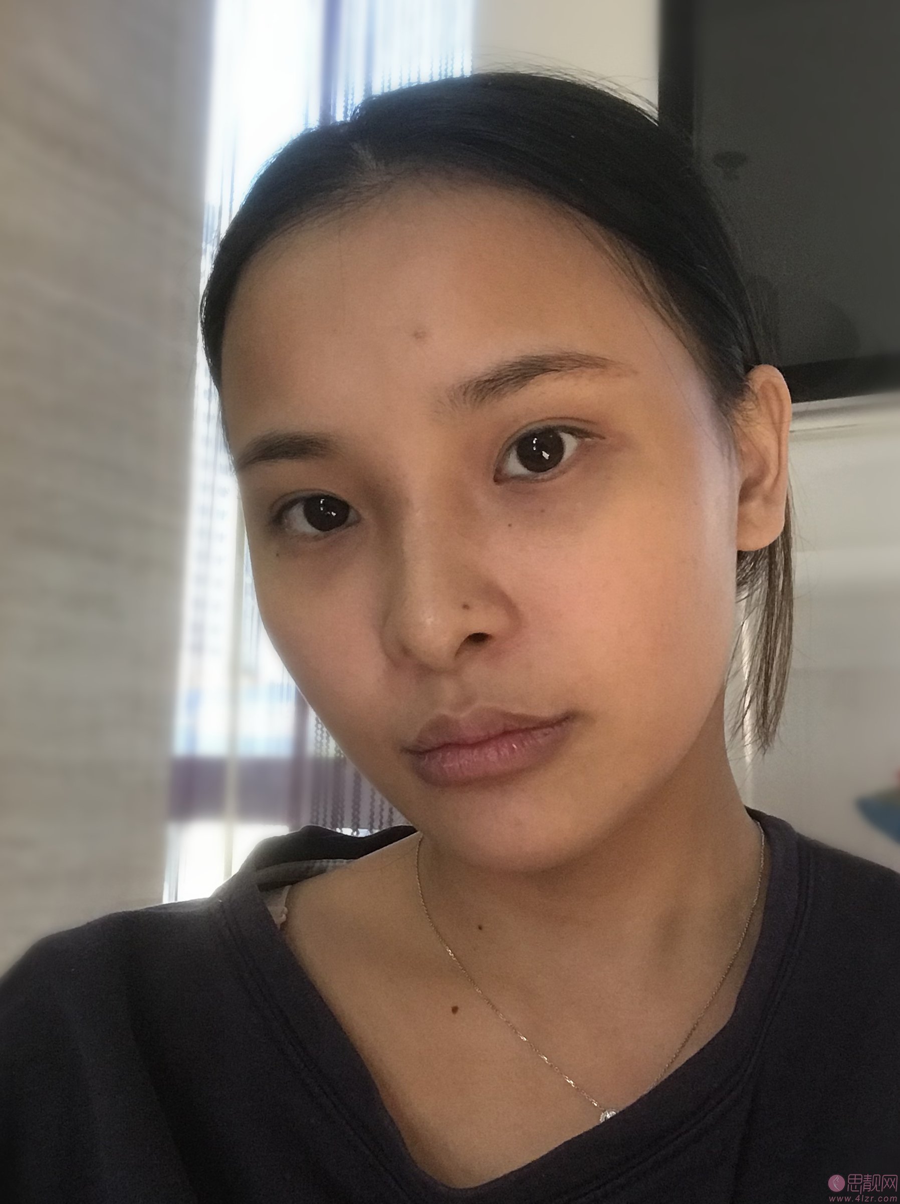 广州曙光医学美容医院张小芸医生祛眼袋如何？2020价格表一览+祛眼袋术后二个月效果