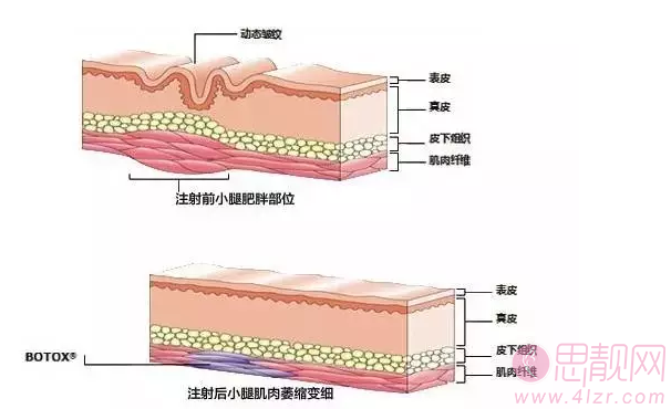 肉毒素瘦腿针的作用 瘦腿针适合哪些人 