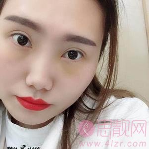 成都美诗沁医疗美容激光祛眼袋怎么样？附祛眼袋术后三个月效果反馈及2020价格表曝光