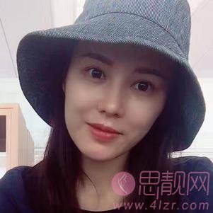 成都美未央医疗美容隆鼻怎么样？2020价格表曝光+隆鼻真人案例分享