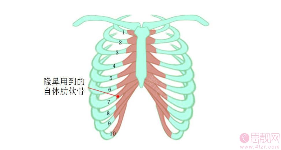 耳软骨隆鼻好还是肋软骨隆鼻好？ 