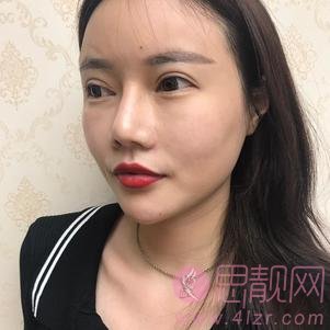 成都医美整形做驼峰鼻矫正手术好不好？2020价格表曝光+驼峰鼻矫正真人案例一览