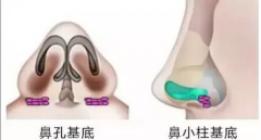 科普|垫鼻基底的好处、材料、价格及后遗症