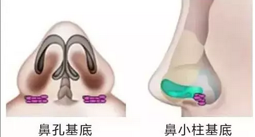 科普|垫鼻基底的好处、材料、价格及后遗症 