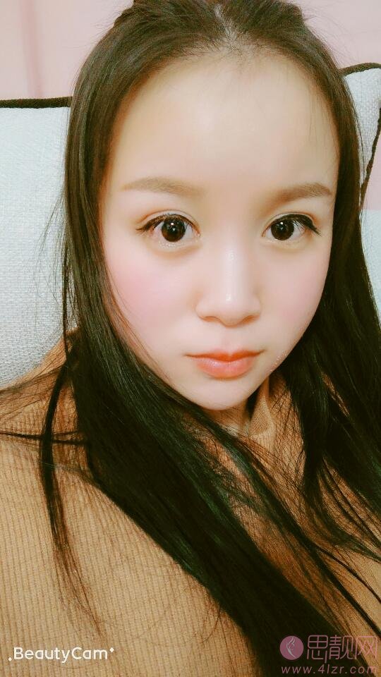 苏州美莱美容医院张亮医生隆鼻好不好？2020价格表曝光+隆鼻真人案例一览