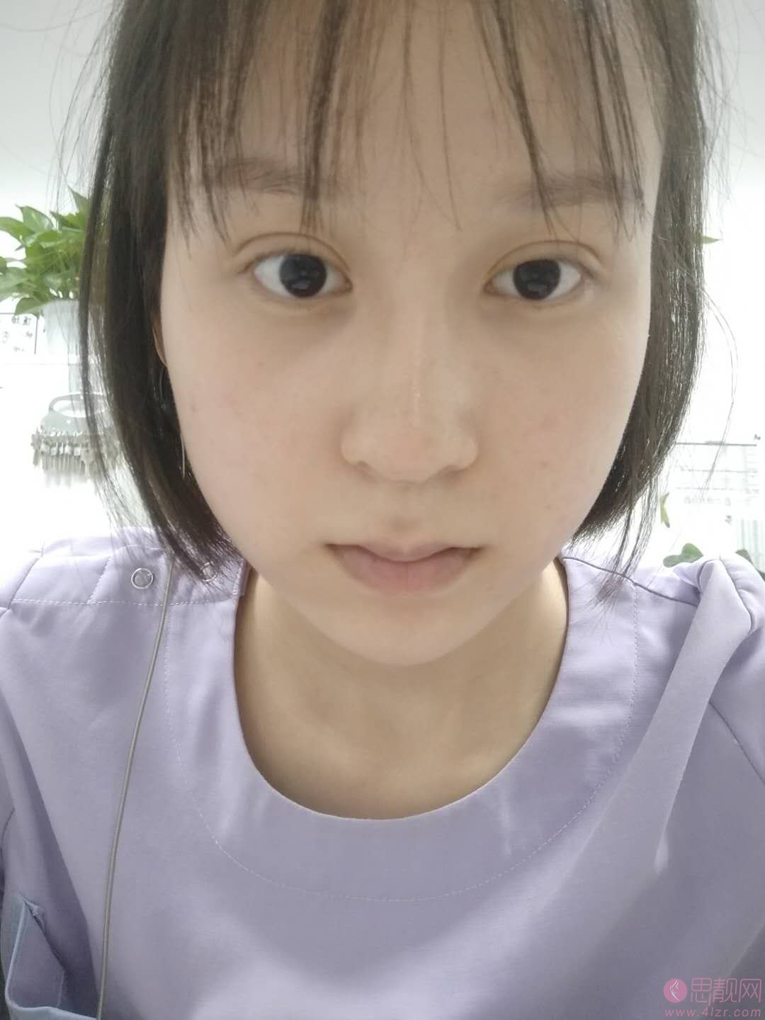 苏州美莱美容医院张亮医生隆鼻好不好？2020价格表曝光+隆鼻真人案例一览