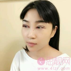 武汉美都医疗美容门诊部做双眼皮手术怎么样？2020价格表出炉+双眼皮术后真人反馈案例