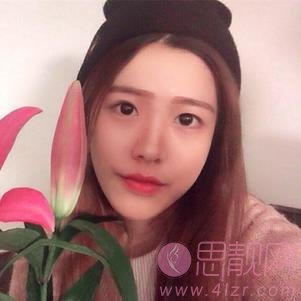 广州美莱医疗美容陈贵宗医生做双眼皮好不好？2020价格表一览+双眼皮术后四个月效果反馈