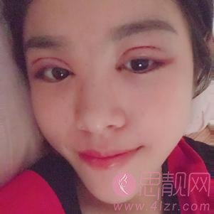 广州美莱医疗美容陈贵宗医生做双眼皮好不好？2020价格表一览+双眼皮术后四个月效果反馈