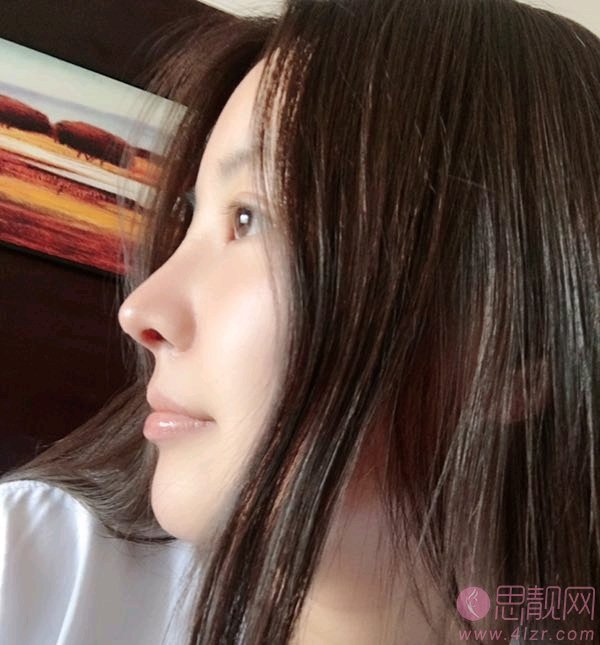 长春久诺美医疗美容（原艾尔丽整形）赵广文隆鼻怎么样？2020价格表出炉+隆鼻真人案例分享