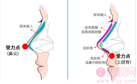 鼻修复需要注意哪些事项