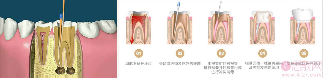 根管治疗后，牙齿到底还能用多久？