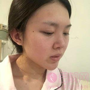 北京东方瑞丽医疗美容门诊部隆鼻怎么样？附隆鼻真人案例一览及2020价格表曝光