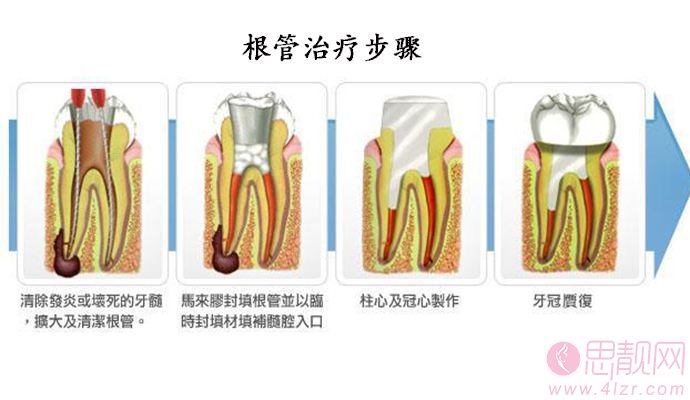 根管治疗后，牙齿还能用多久？ 