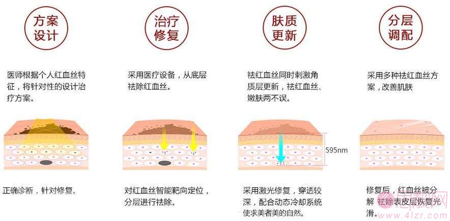 科普|激光去除红血丝的原理？激素脸红血丝可以用激光吗？