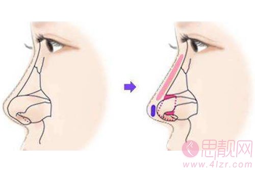 科普|全肋骨隆鼻与半肋骨隆鼻有何区别？