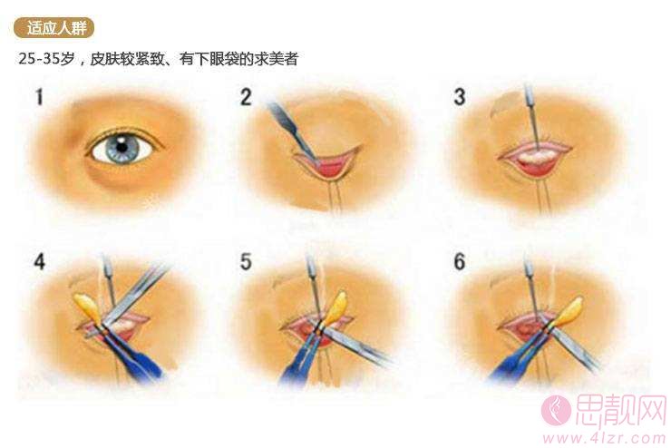 科普|祛眼袋有哪些方法？哪些人不适合做祛眼袋手术以及祛眼袋术后如何