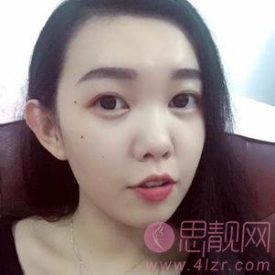 广州可玫尔艺美医疗美容李闯隆鼻怎么样？附隆鼻术后真人案例一览及2020价格表曝光