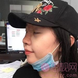 广州可玫尔艺美医疗美容李闯隆鼻怎么样？附隆鼻术后真人案例一览及2020价格表曝光