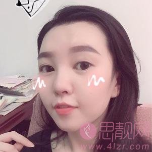 广州可玫尔艺美医疗美容李闯隆鼻怎么样？附隆鼻术后真人案例一览及2020价格表曝光