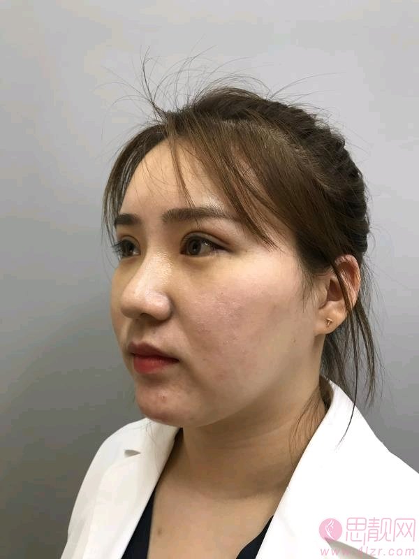 北京彤美医美美容门诊部刘风卓做双眼皮好不好？2020价格表上线+双眼皮真人案例分享