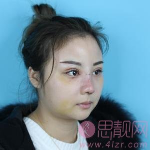 长沙美德思医疗美容隆鼻好不好？2020价格表发布+真人案例分享