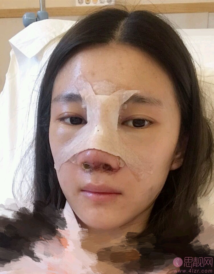 长春医美美容医院高博隆鼻效果好不好？2020价格表一览+案例分享