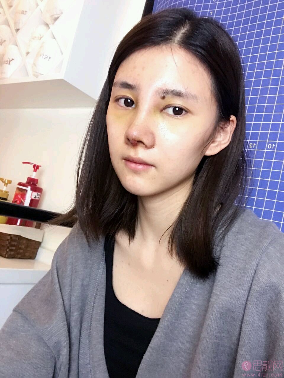 长春医美美容医院高博隆鼻效果好不好？2020价格表一览+案例分享