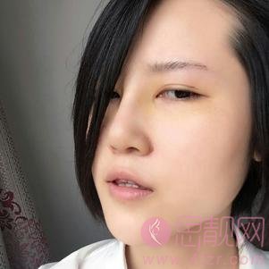 苏州眼耳鼻喉科医院医疗美容科柴梅隆鼻好不好？2020价格表发布+隆鼻案例分享