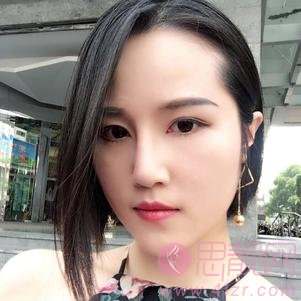 苏州眼耳鼻喉科医院医疗美容科柴梅隆鼻好不好？2020价格表发布+隆鼻案例分享