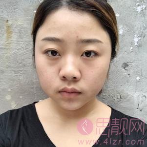 绵阳茗汇整形美容医院隆鼻好不好？2020价格表发布+隆鼻案例分享