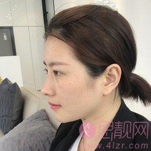 惠阳长安医院医疗美容科邹海昌做皮秒激光好不好？2020价格表曝光+皮秒激光真人案例分享