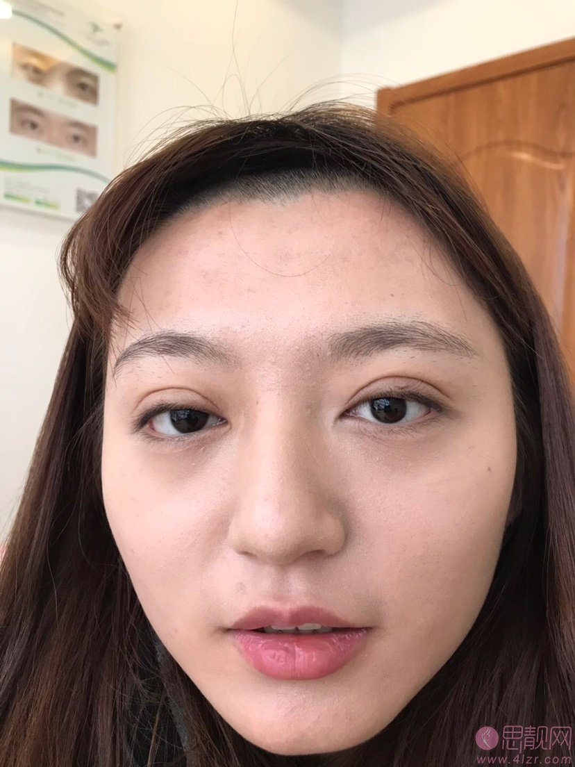 深圳美莱医疗美容医院陈芝双眼皮修复怎么样？2020价格表曝光+双眼皮术后真人案例分享