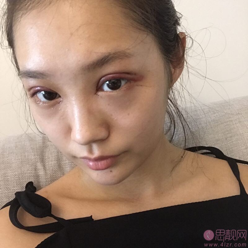 重庆美仑美奂整形美容医院董开云做双眼皮手术好不好？2020价格表一览