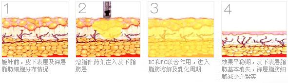 溶脂针有什么优势和功效？