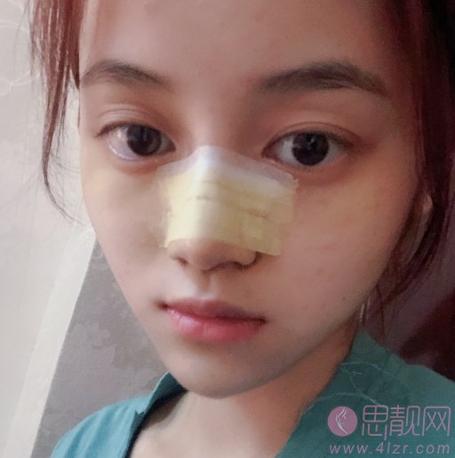 成都锦江纽蜜医疗美容隆鼻好不好？2020价格表曝光+隆鼻真人案例一览