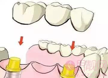 种植牙和镶牙的区别？ 