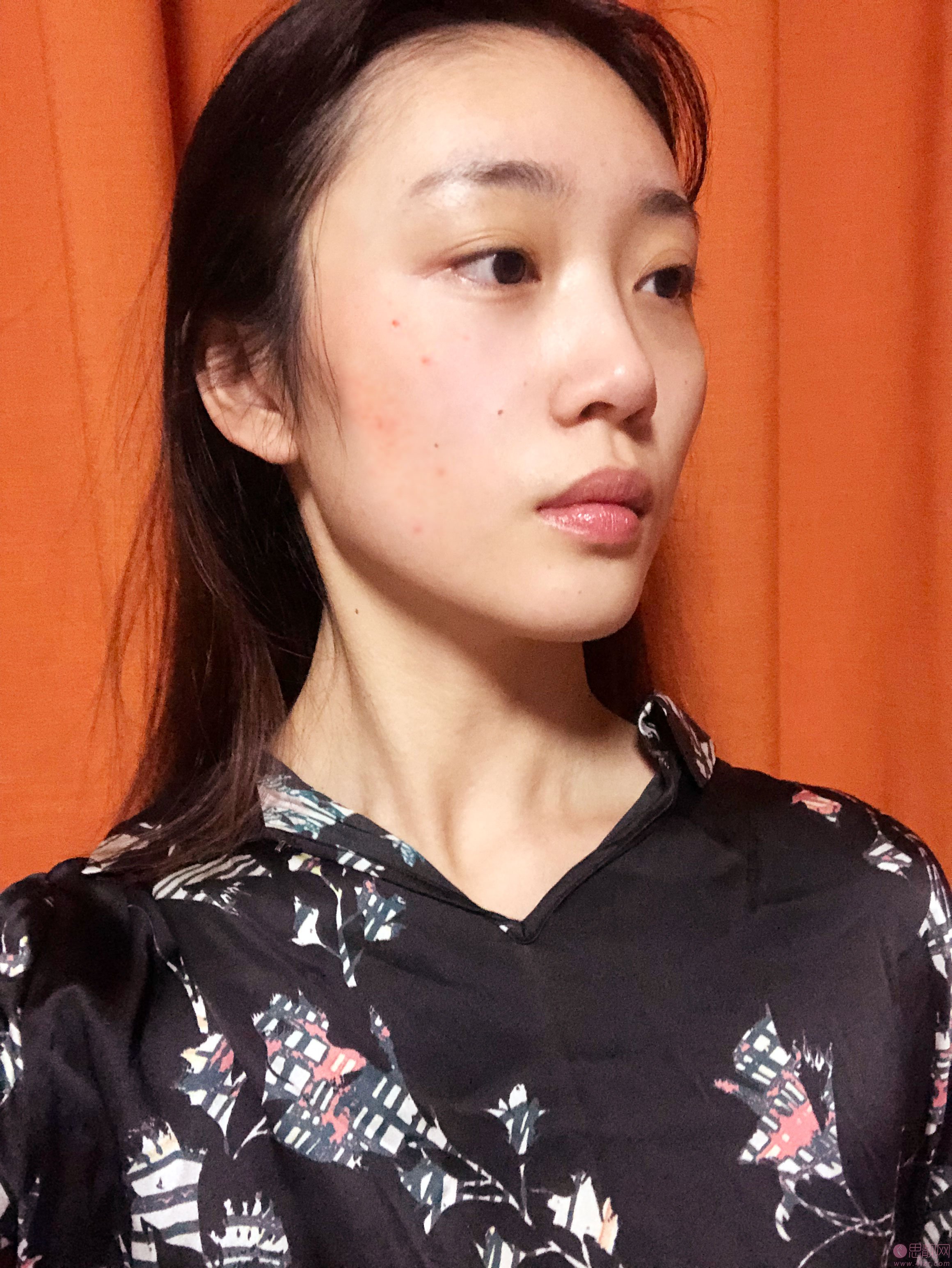  北京惠合嘉美医疗美容诊所2020价格表一览+埋线提升真人案例一览