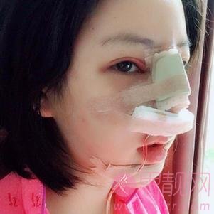 贵阳美莱医疗美容医院隆鼻怎么样？附隆鼻案例及2020价格表一览