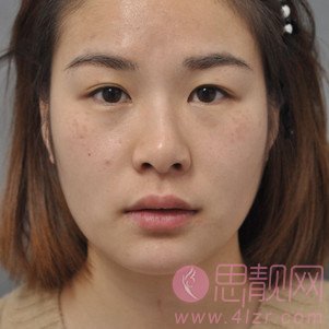 武汉蜜司医疗美容杨蓉做双眼皮好不好？附双眼皮案例一览及2020价格表曝光